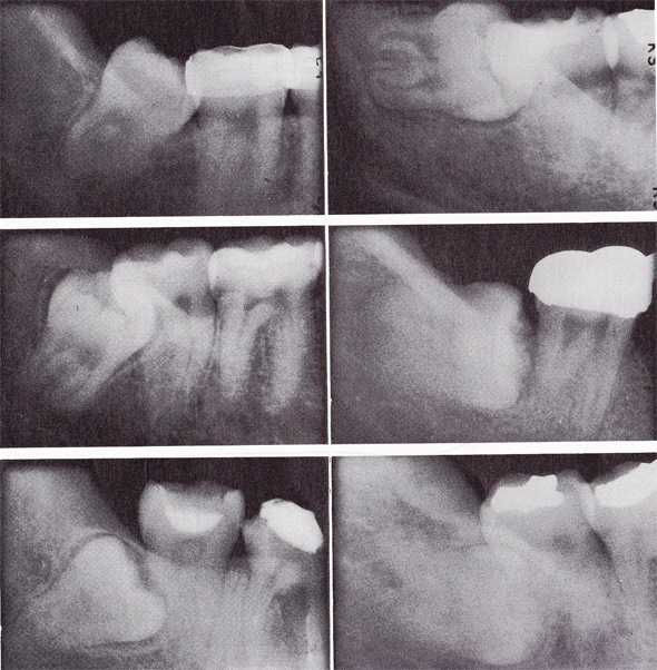 埋まった下の親知らずのX線写真1993、学建書院、「これからの抜歯」から