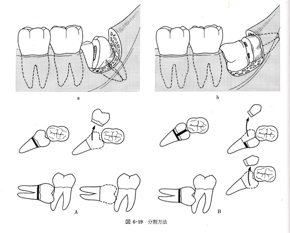 「これからの抜歯」から　分割方法