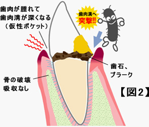 【図2】　・歯肉が腫れて歯肉溝が深くなる（仮性ポケット）　・骨の破壊、吸収なし　・歯石、プラーク　←歯肉溝へ突撃！！