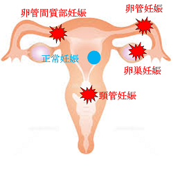 お腹の下の痛み、異常な性器出血がある